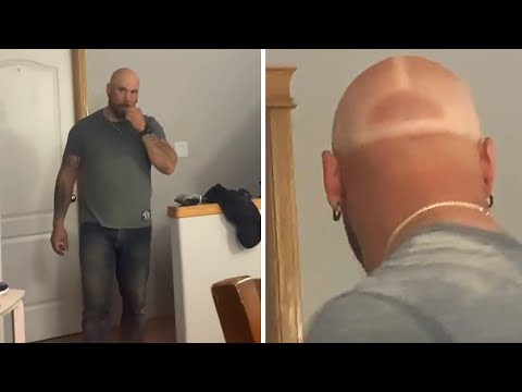 This Guy Experiences Every Bald Person's Worst Nightmare When They Forget To Apply Sunscreen