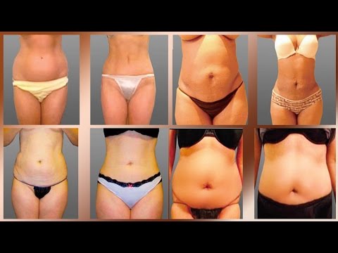 Liposuction Cosmetic Surgery Before and After in Mexicali Mexio 