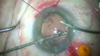 Download Lagu kosko 15 year old post yag multifocal exchanged to light adjustable lens Thumbnail