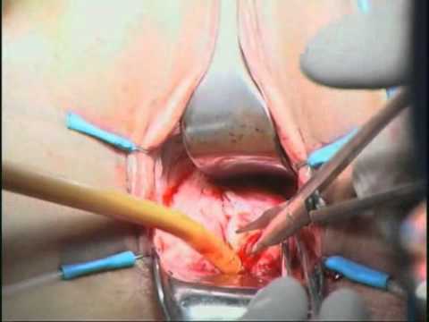 Radiation Induced Vesicovaginal Fistula - Treatment