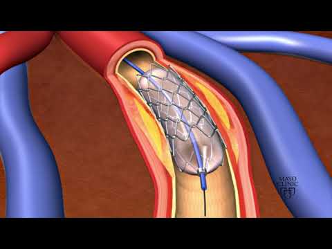 Animation - Coronary stent placement