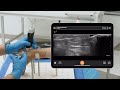 Effective Achilles Tendinopathy Injections