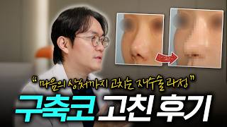 EDITION TV - 코 수술 후 염증, 구축이 생겨 고생하고 있진 않으신가요? 자세한 치료 후기