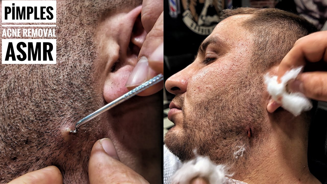 PİMPLES REMOVAL ON FACE | ASMR MASSAGE FOR SLEEP AND RELAXATİON | PROFESSİONAL HEAD MASSAGE