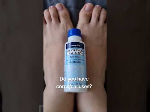 How to remove foot corns and calluses