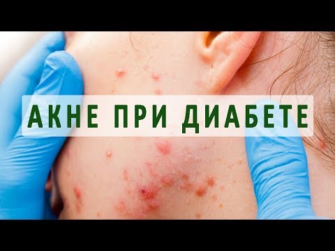 Крем лирене отбеливающий Как избавиться от возрастных пигментных пятен на руках и лице