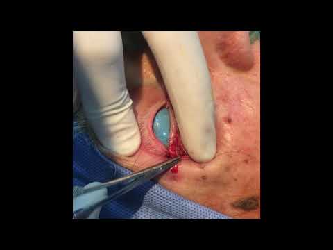 Cantoplastia tarsal strip