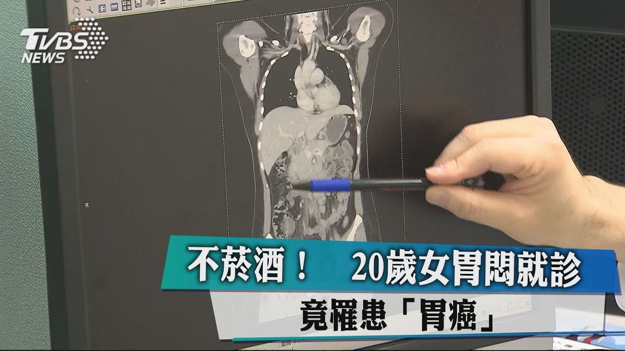 不菸酒！20歲女胃悶　就診竟罹患「胃癌」