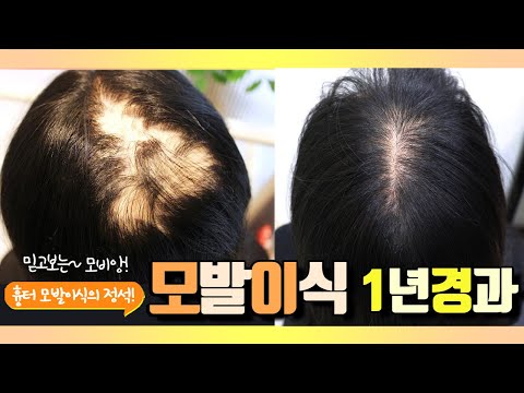 20대 중반 여성,비절개 3500모 정수리 화상 모발이식 1년 경과영상!