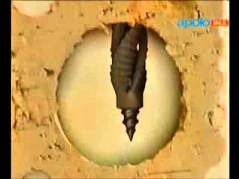 Chevilles de fixation multi matériaux - fixation profesionnelle Apolo chez Hardeman