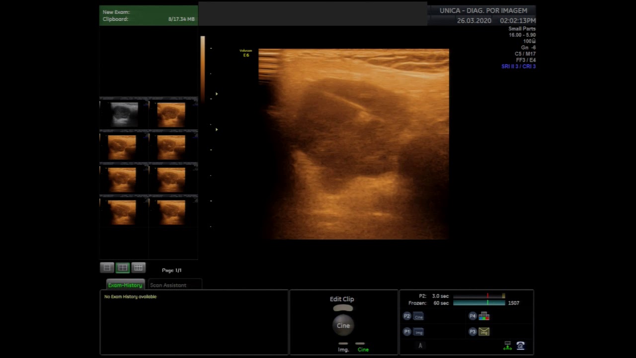 Biópsia dirigida por ultrassom