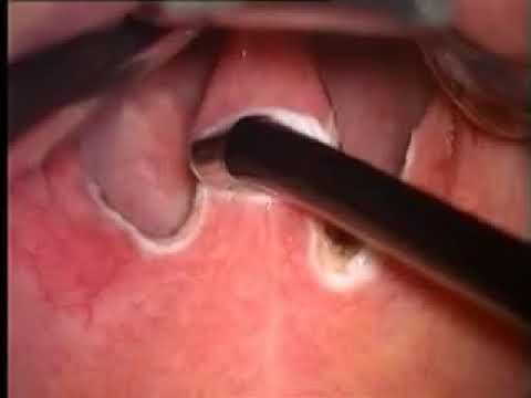 uvula papillómával gasztrovaszkuláris párnával ellátott platyhelmintek