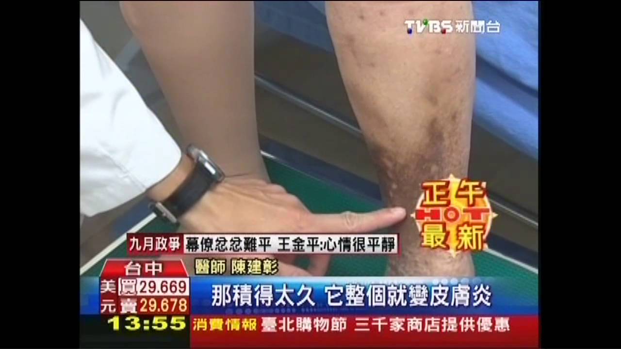 腳踝潰爛3年難癒合　原來是靜脈曲張