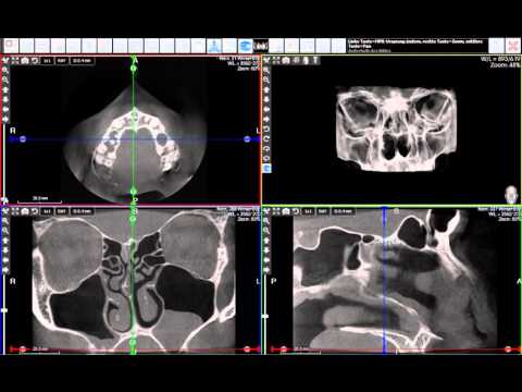 DORNMEDICAL GmbH - Acteon X-Mind Trium HNO NNH
