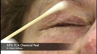 35% TCA Chemical Peel by Dr. Edwin Williams for Wrinkles & Sun Damage