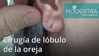 Cirugía de lóbulo de la oreja (17050)