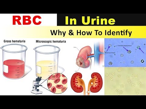 RBC In Urine ( Why & How to Identify )