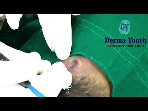 Derma Touch Treating Naevus on Chin.