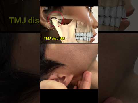 Temporomandibular joint disorder and treatment #tmj #dental #dentist