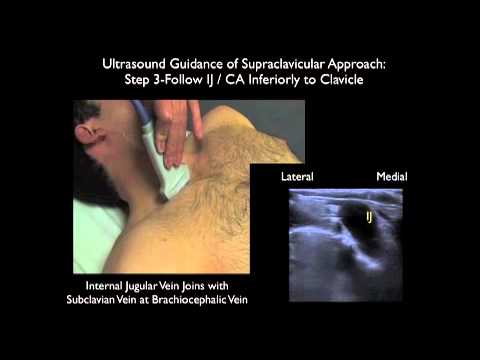How To: Supraclavicular Approach to Subclavian Vein Cannulation - Sonosite Ultrasound