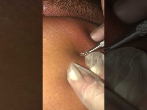 Extracting some nice blackheads. Satisfying.