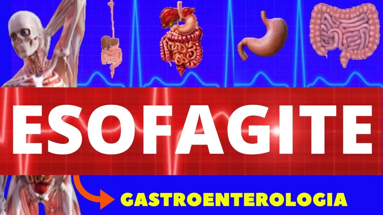ESOFAGITE - O QUE É, CAUSAS, SINTOMAS, DIAGNÓSTICO E TRATAMENTO - GASTROENTEROLOGIA