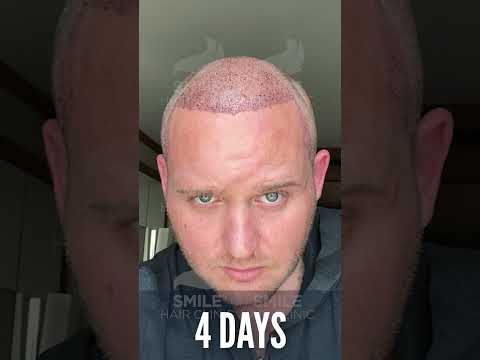 HAIR TRANSPLANT BEFORE AND AFTER - 6 MONTHS!
