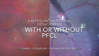 Macular hole and retinal detachment - ILM peeling techniques with or Without PFCL