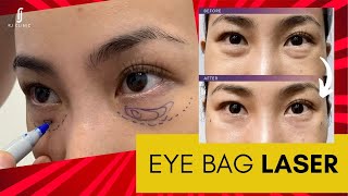 Non-Surgical Eye Bag Laser Treatment: Say Goodbye to Under-Eye Bags