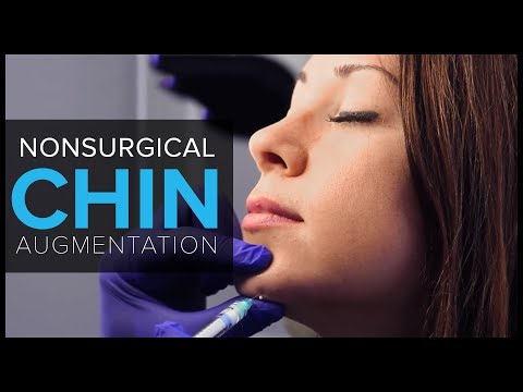 download lagu mp3 mp4 Non Surgical Chin Augmentation Before And After, download lagu Non Surgical Chin Augmentation Before And After gratis, unduh video klip Non Surgical Chin Augmentation Before And After