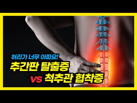 허리 통증 정체는? 추간판 탈출증, 척추관 협착증 구분법