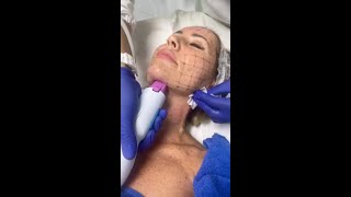 Thermage FLX ®; radiofreciencia para tensado y cotornos en  Clínica Estética Médica Dermonova Málaga