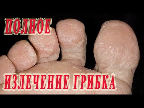 Das Pech bei gribke die Füsse Der Chili von gribka der Nägel