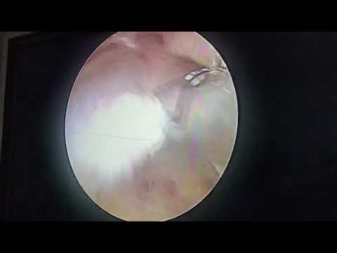Rotator cuff tear shoulder