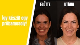 Így készül egy próbamosoly! Páciensünk élményei
