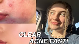 HOW TO REALLY CLEAR ACNE FAST !! // skincare routine