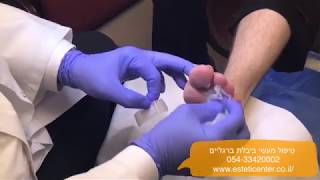 טיפול ביבלת