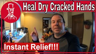 How to Heal Dry Cracked Hands