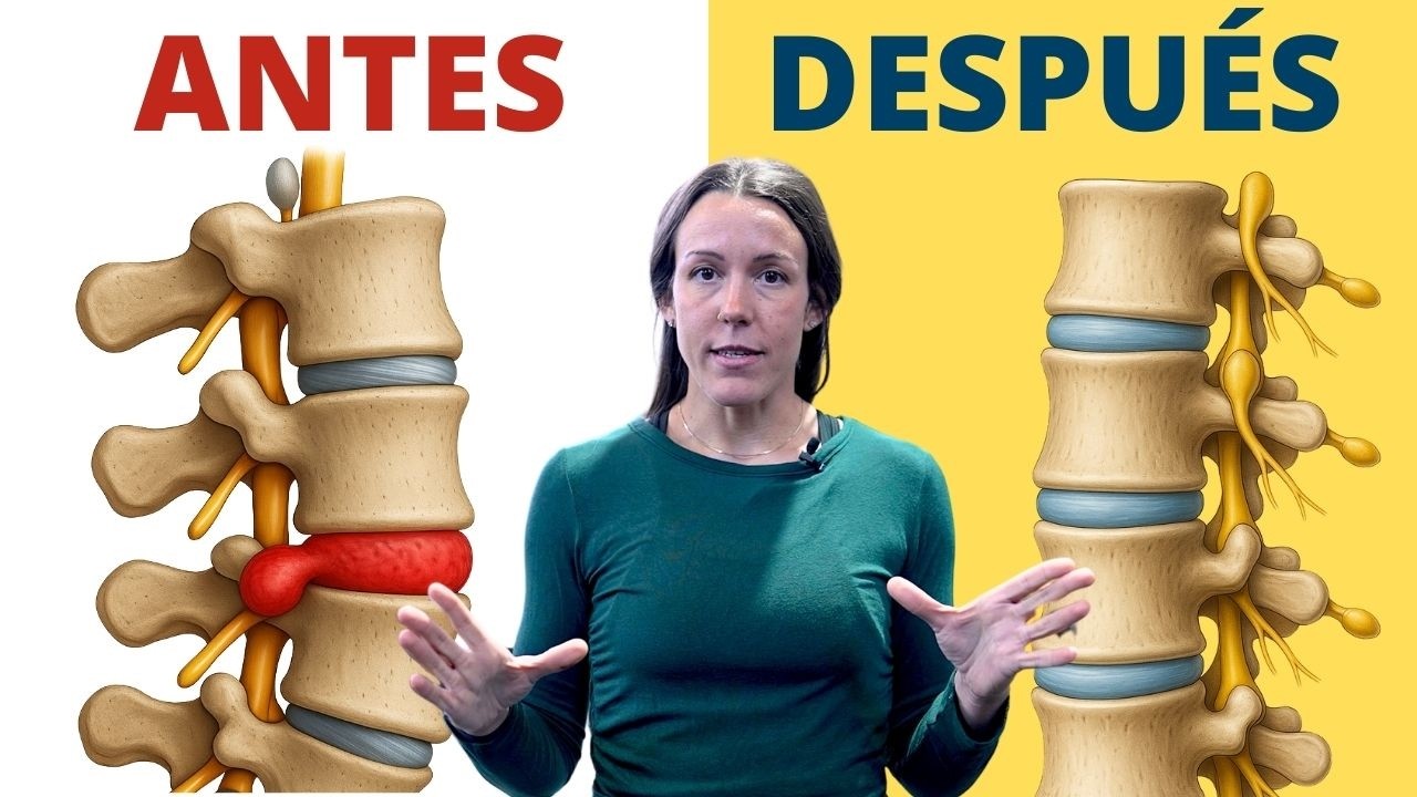 Exercises to Treat Your Herniated Disc - Do These Before Surgery!