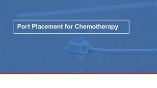 Port placement for chemotherapy