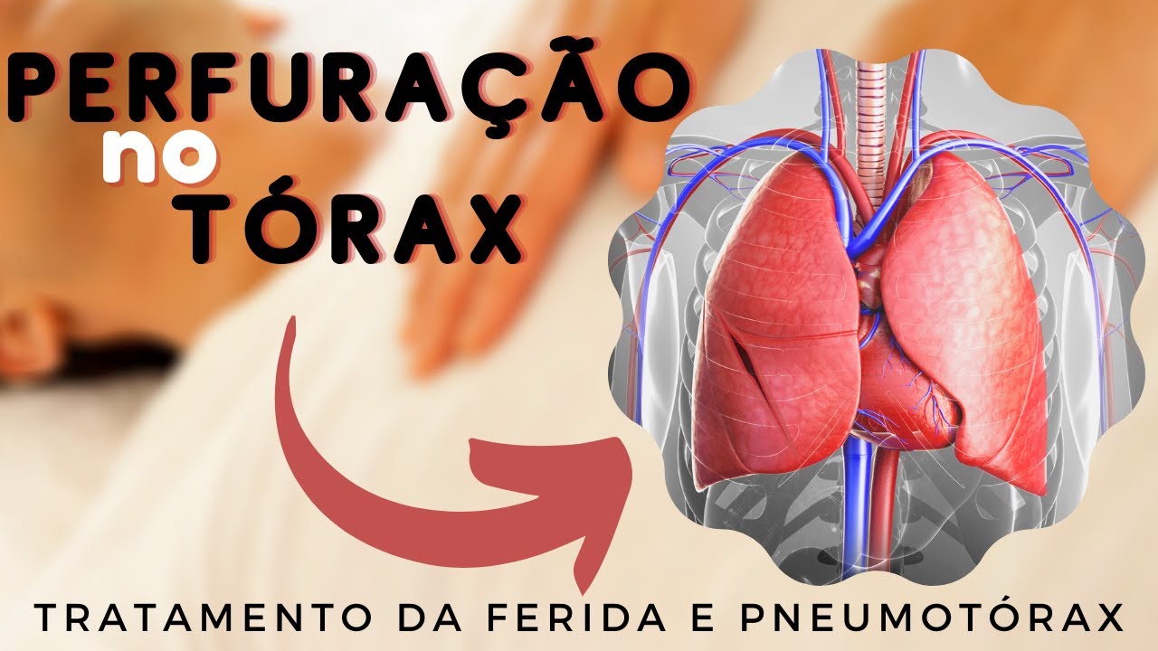 PNEUMOTÓRAX - O que fazer com ferimento no tórax? Saiba o que é o Pneumotórax