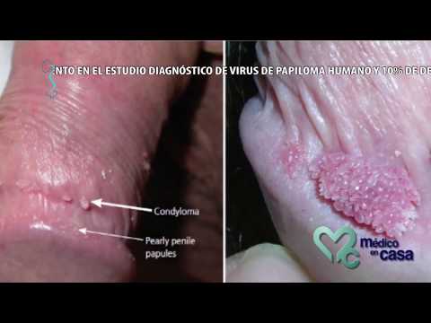 Papilloma tongue pictures
