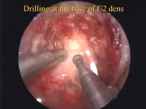 Ενδοσκοπική διαστοματική εκτομή του οδόντος