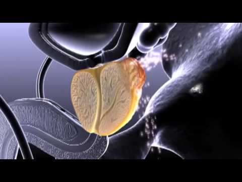 Ein wirksames Heilmittel für Prostatitis MRT bei Prostatakrebs