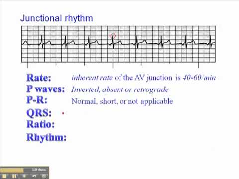 ECG: Junctional Rhythm