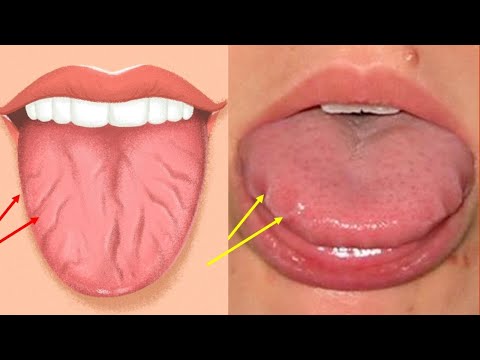 Schau, was Linien und Rissen auf deiner Zunge über deine Gesundheit verraten