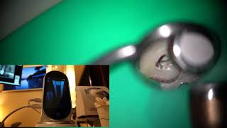 【Case Sharing】MTA filling with Ai-pex and Ai motor in T-mode