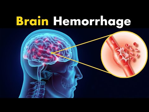 What Happens in Brain hemorrhage? | Symptoms, Causes and Treatment (3d animation)