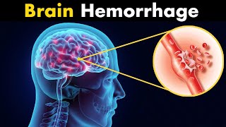 What Happens in Brain hemorrhage? | Symptoms, Causes and Treatment (3d animation)