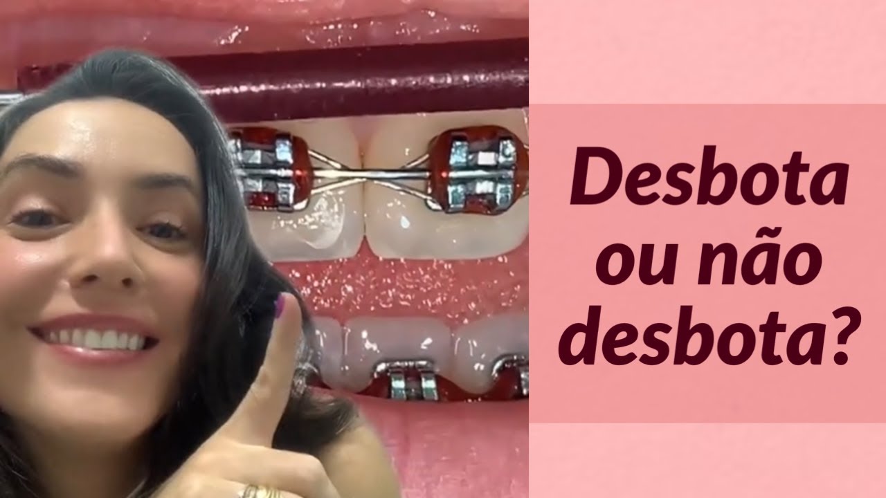 DESBOTA OU NÃO DESBOTA CORES PARA BORRACHINHA DO SEU APARELHO ORTODÔNTICO